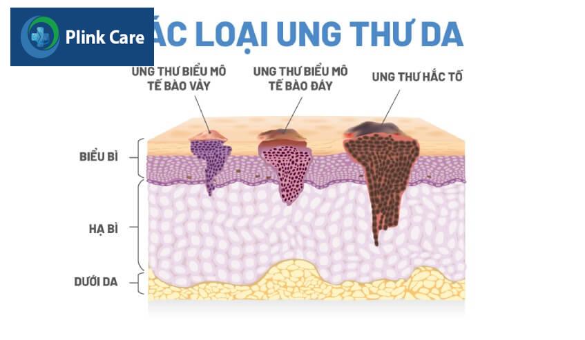 ung thư sắc tố có nguy hiểm không