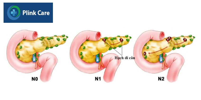 ung thư tuyến tụy phân đoạn n