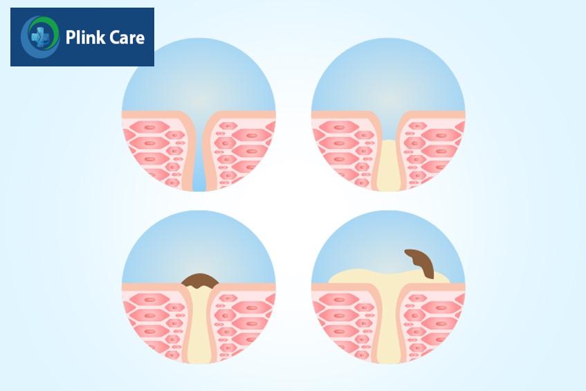 Nặn mụn đầu đen, vi khuẩn bên trong mụn được giải phóng, lan sang các lỗ chân lông xung quanh, gây nổi mụn nhiều hơn.