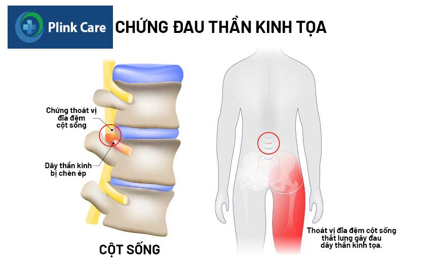vị trí xuất hiện của cơn đau thần kinh tọa