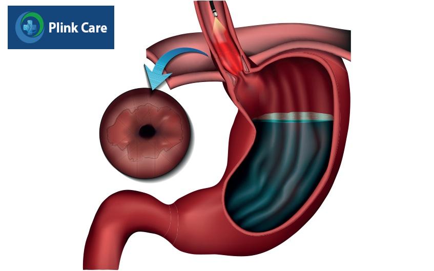 viêm thực quản trào ngược là gì
