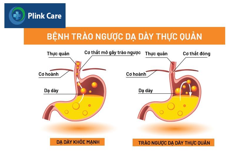 viêm trào ngược thực quản độ a