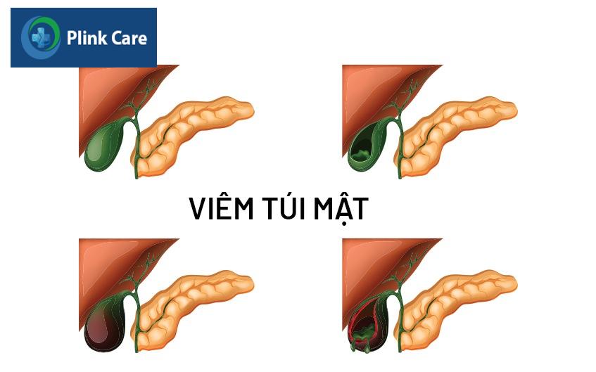 viêm túi mật mãn tính