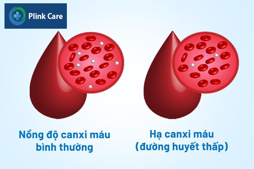 xác định Hạ canxi máu