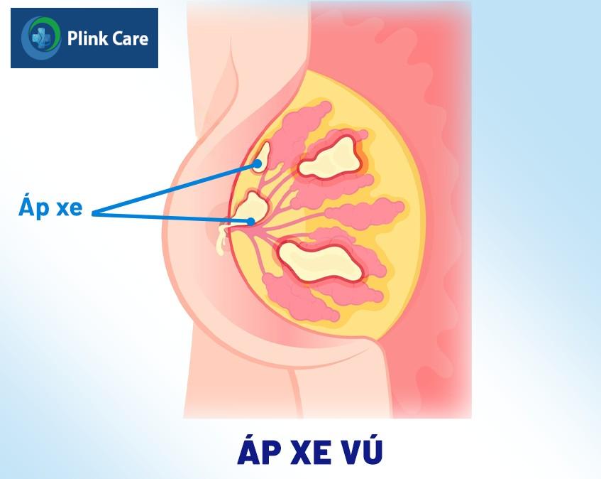 áp xe