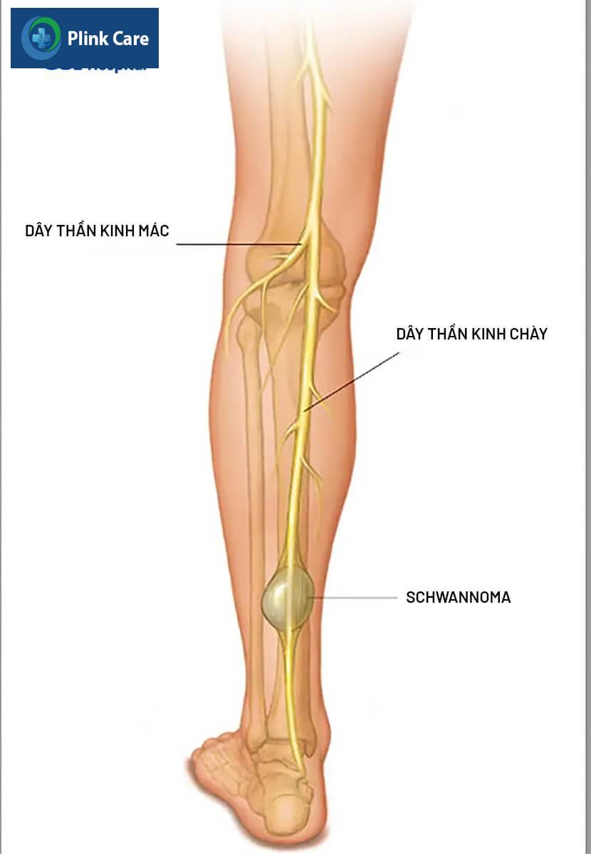 bệnh schwannoma