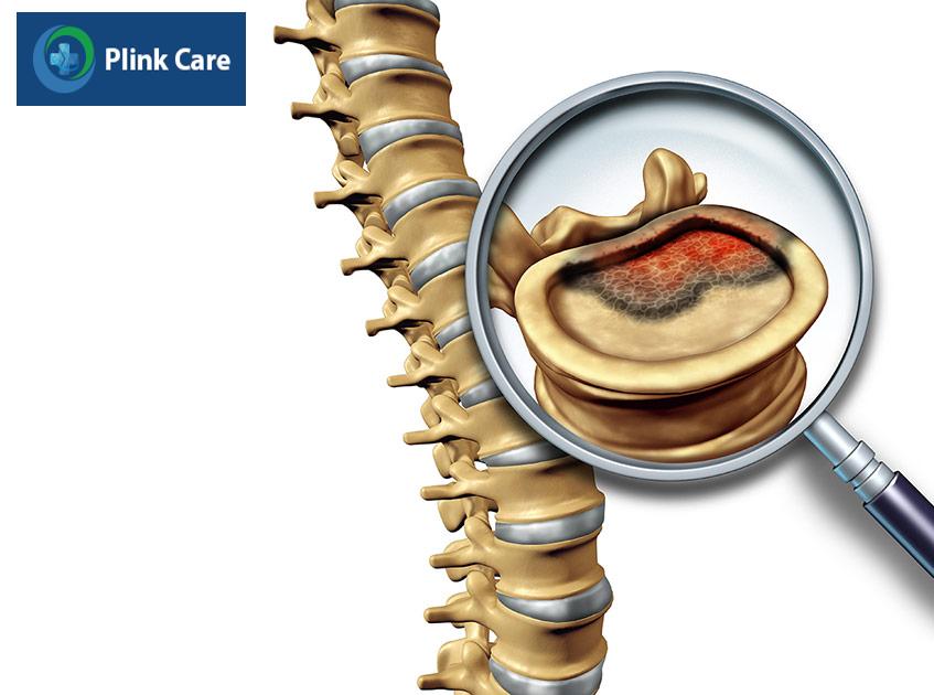 Bệnh u trong ống sống là các khối u xuất phát trong ống sống ở cột sống