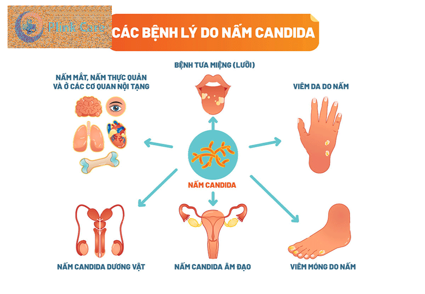 các bệnh lý do nấm candida