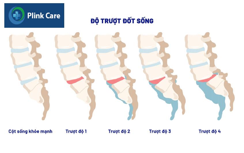 các cấp độ lệch đốt sống