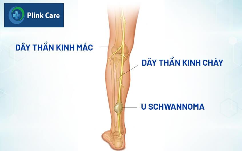 các loại u thần kinh ngoại biên