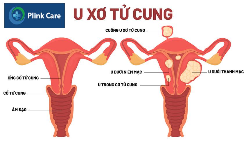 các loại u xơ tử cung