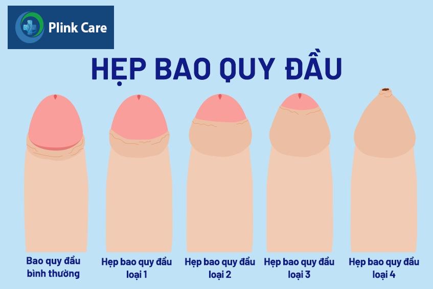 Hẹp bao quy đầu quá mức là một trong các nguyên nhân cần cắt bao quy đầu