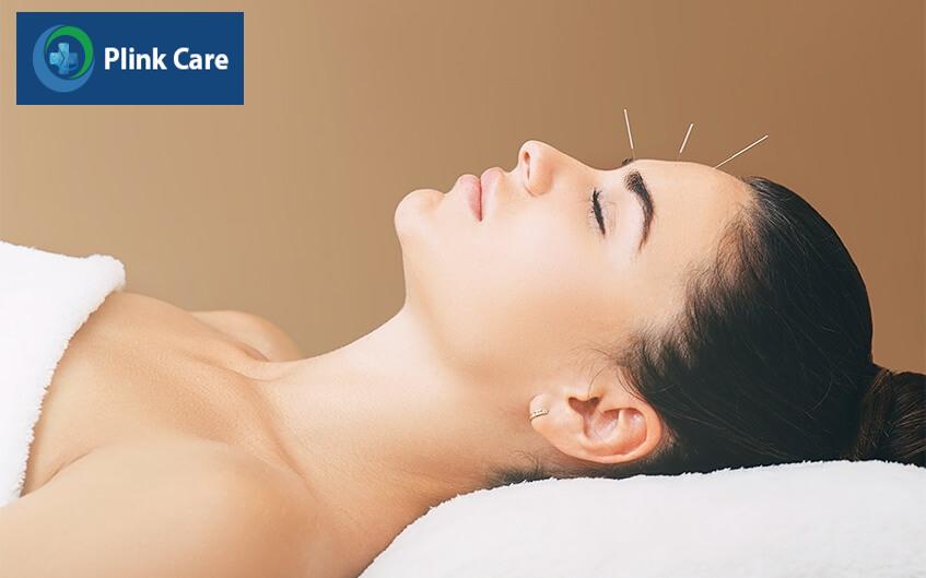 cách trị chóng mặt bằng châm cứu