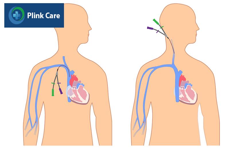 Catheter lọc máu