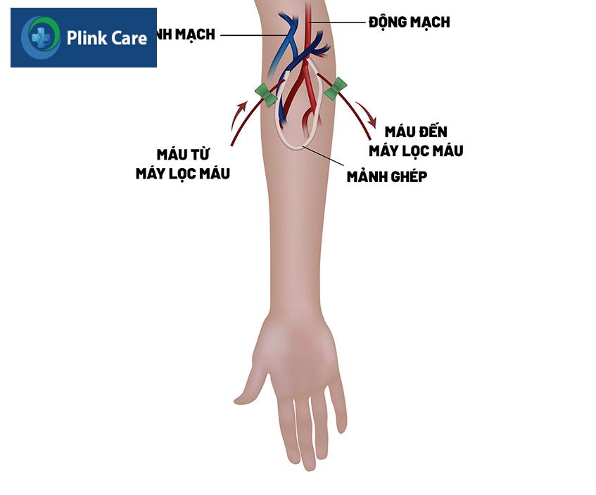 Cầu nối động tĩnh mạch bằng ống ghép mạch máu nhân tạo (AVG, Arteriovenous graft)