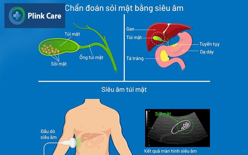 chẩn đoán bệnh sỏi mật