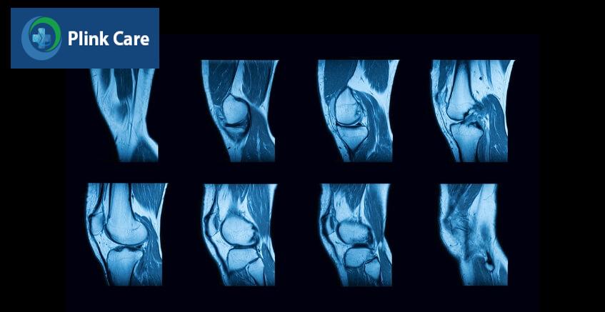 chẩn đoán bệnh viêm dây thần kinh ngoại biên