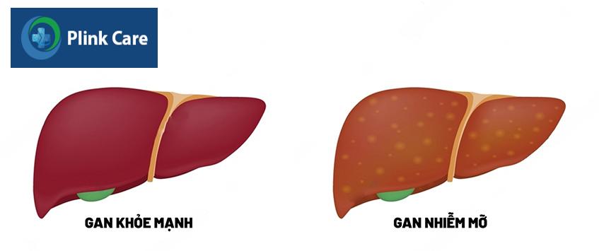 Cholesterol tích tụ lại quá nhiều dẫn đến tình trạng gan nhiễm mỡ