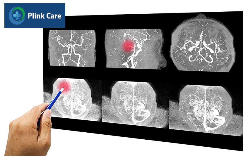 Dị dạng mạch máu não có thể gây xuất huyết não