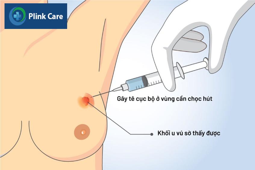 fna tuyến vú là gì