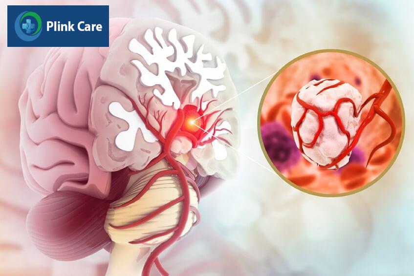 khối u nguyên bào thần kinh đệm
