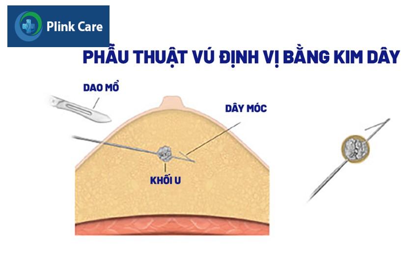 mổ vú định vị bằng kim dây