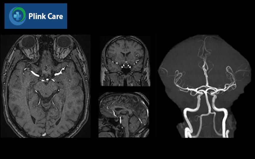 mri mạch máu não không thuốc tương phản