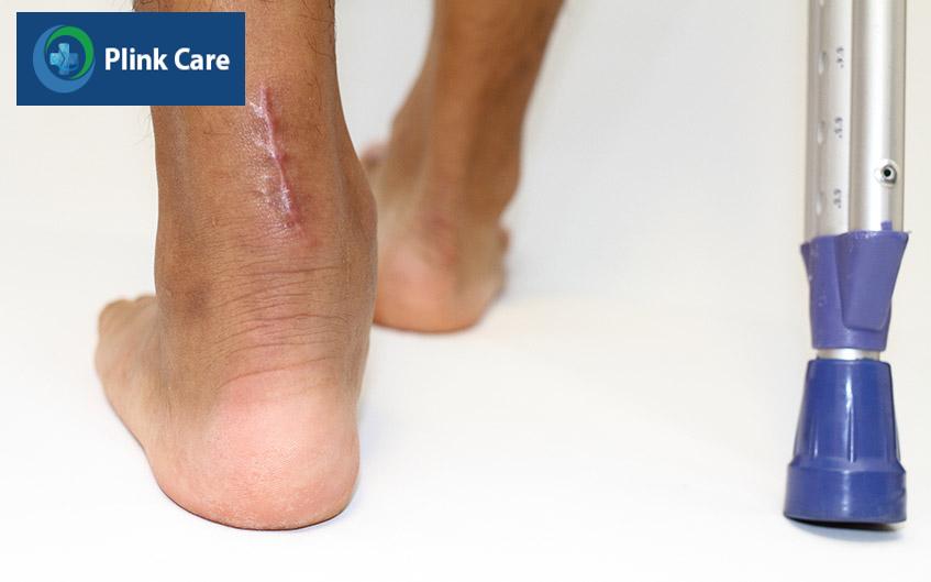 phục hồi chức năng sau nối gân achilles