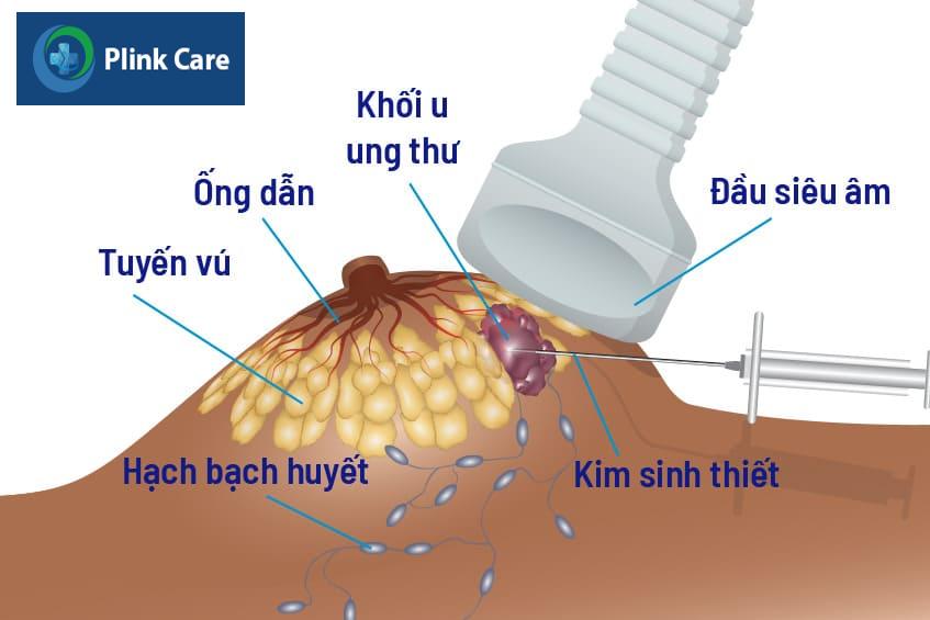 chẩn đoán Ung thư vú thể nội tiết dương tính