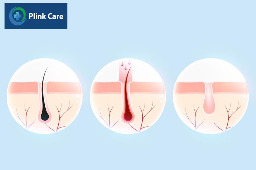 Quy trình tác động vào nang lông, triệt lông nhanh chóng và hiệu quả