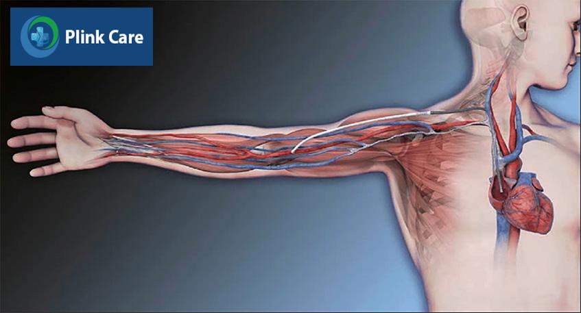 Thiết bị HeRO graft