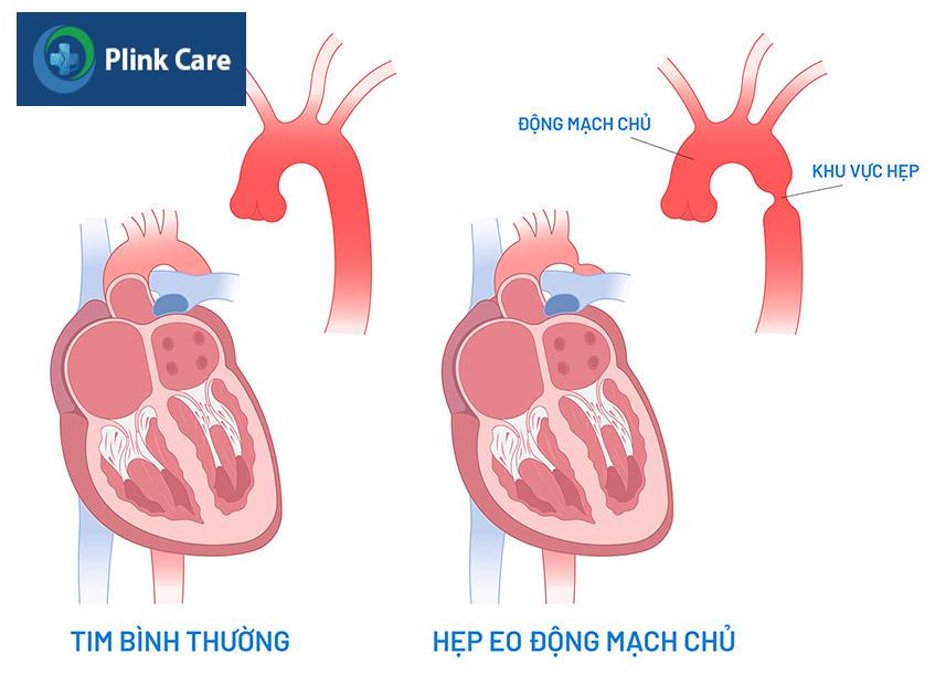 Hẹp eo động mạch chủ làm hạn chế lưu lượng máu đi qua đoạn hẹp