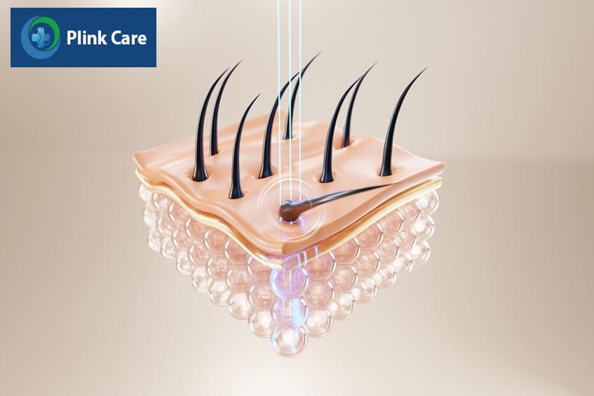 Triệt lông tác động sâu vào nang lông