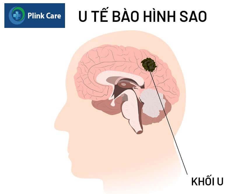 u tế bào sao là khối u thần kinh đệm