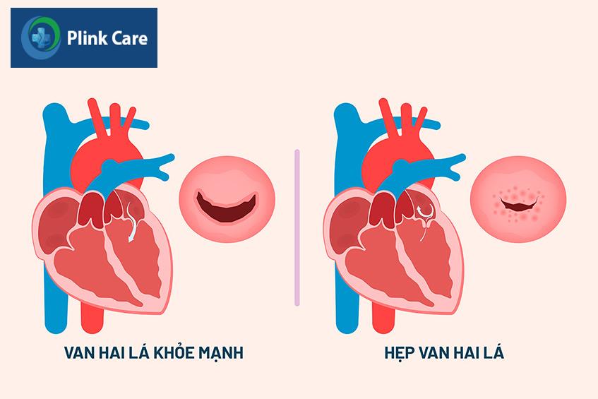Van hai lá bị hẹp khít cần được chỉ định thay van