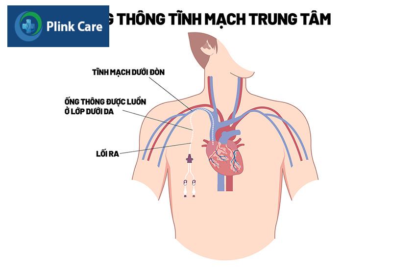 Vị trí tiếp cận để đặt catheter có đường hầm chạy thận nhân tạo