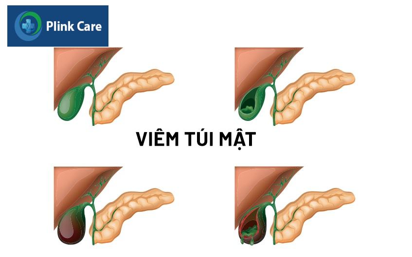 viêm túi mật