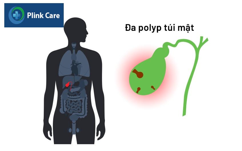 bệnh đa polyp túi mật