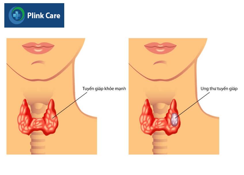 bệnh ung thư tuyến giáp thể tủy