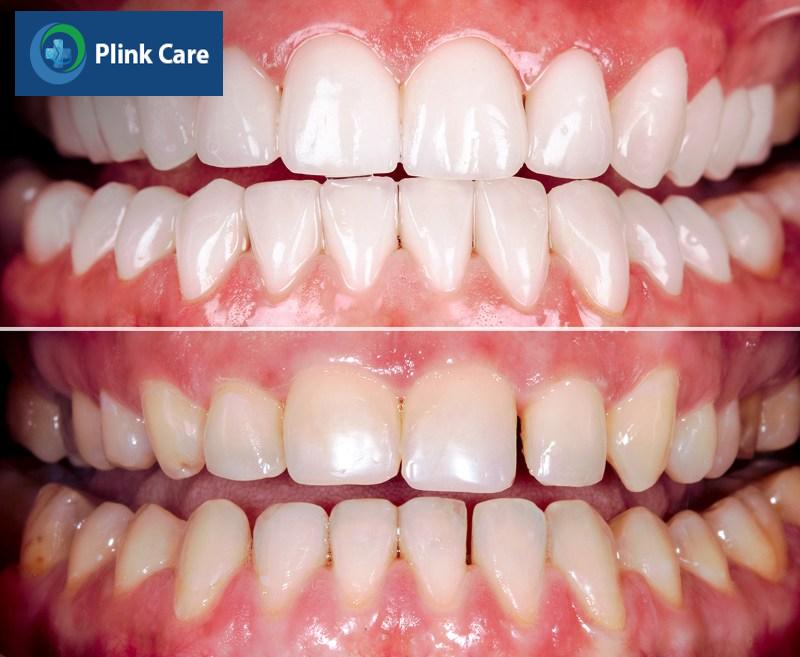 Phục hình răng là gì?