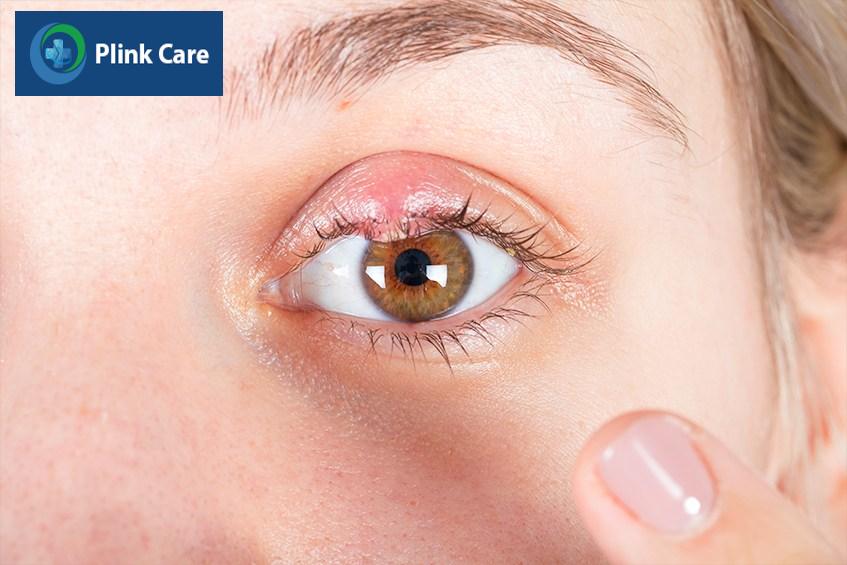 cách trị mụt lẹo