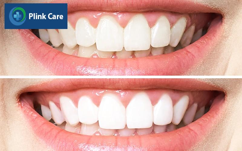 Tại sao phải chăm sóc răng miệng đúng cách?