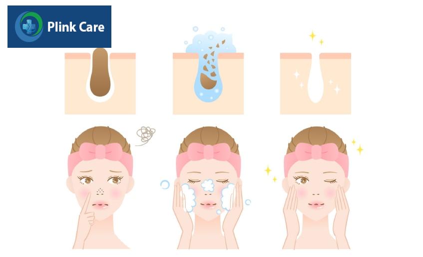 cách làm hết sạch mụn đầu đen tại nhà