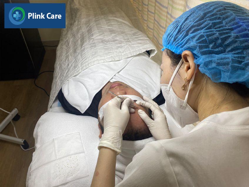 điều trị mụn đầu đen cho bệnh nhân