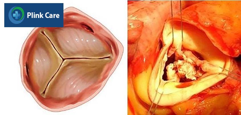 Hình ảnh sùi trên van ở bệnh nhân viêm nội tâm mạc nhiễm khuẩn