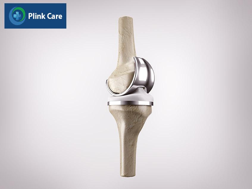 kỹ thuật căn chỉnh trong thay khớp gối