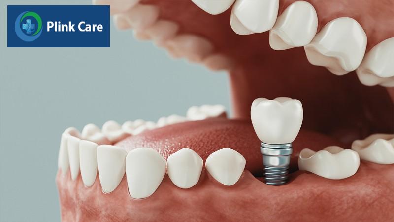 kỹ thuật phục hình răng, phục hình răng sứ trên implant