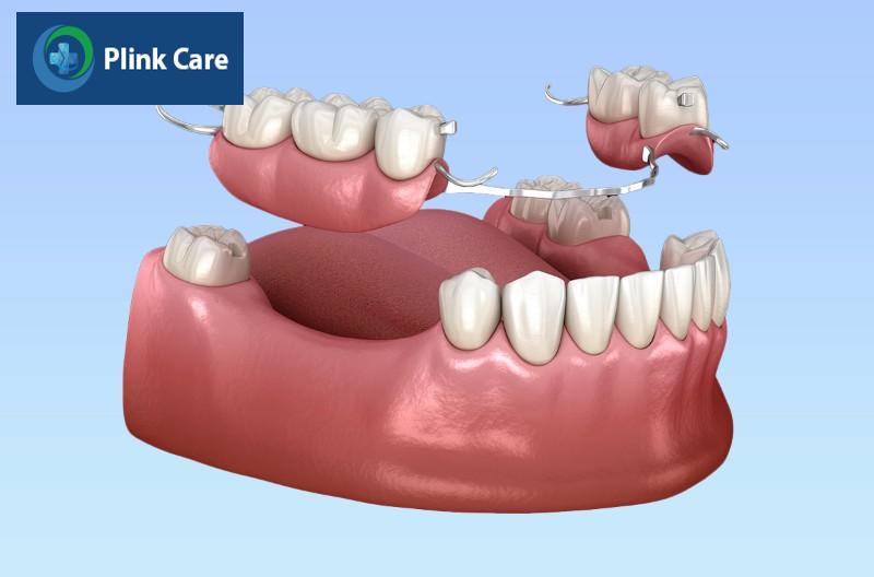 Các loại phục hình răng, phục hình tháo lắp