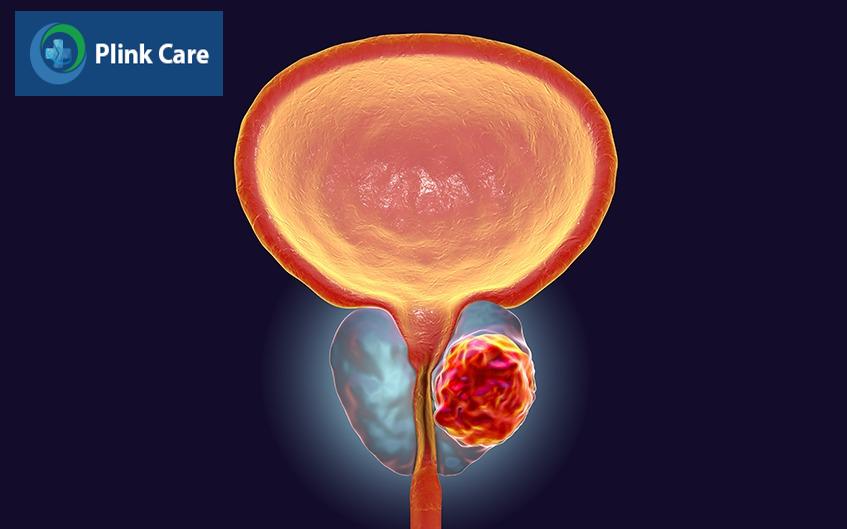 kỹ thuật sinh thiết tiền liệt tuyến