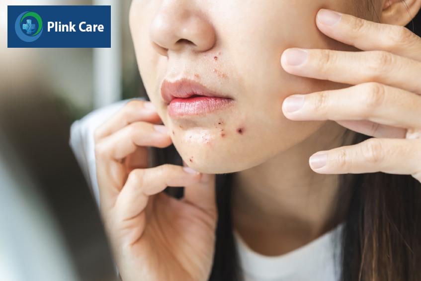 ngăn ngừa mụn cám quanh miệng